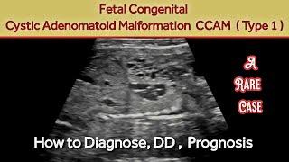 Fetal Cystic Adenomatoid Malformation  CCAM  CPAM  OBS Ultrasound  Fetal Congenital Anomaly Scan [upl. by Lertnek205]