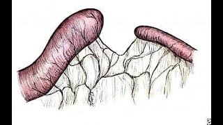 Jejunoileal atresia history and etiology [upl. by Lanna]