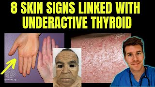 Doctor explains 8 SKIN SIGNS linked with HYPOTHYROIDISM aka underactive thyroid [upl. by Kylstra]