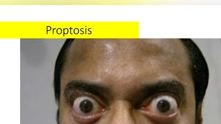 Proptosis  etiology type and work up protocol [upl. by Hinkle451]