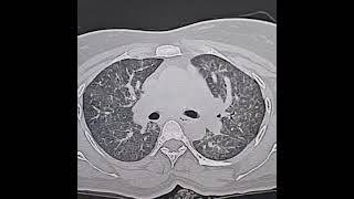 Desquamative interstitial pneumonia [upl. by Okajima]