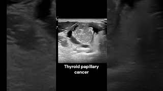 Thyroid Papillary Cancer ultrasound imaging radiology cancer endocrinology cases [upl. by Jeremiah]