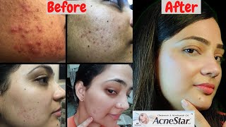 Acne star Gel And Lotus organics Plant Retinol Miracle Face oil Review Best for acne  Pimple [upl. by Nare]