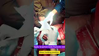 Pop cast for scaphoid bone fracture orthopedics shortvideo [upl. by Nennek]