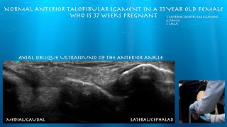 Ultrasound of a Normal Anterior Talofibular Ligament in a 33 Year Old Female [upl. by Hanus]