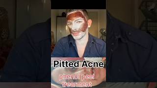 ACNE PHENOL PEEL USMLE NEET SHORTS [upl. by Robaina]