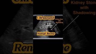 Renal Stones  Ureteric VUJ Stone  Hydronephrosis Hydroureter Ultrasound [upl. by Ahsekyt]