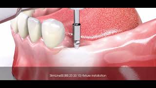 Prothèse amovible CLIPSÉ sur implant bouton pression [upl. by Chud439]