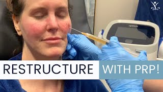 What is a PRP Facelift Are There Any Risks [upl. by Apilef665]