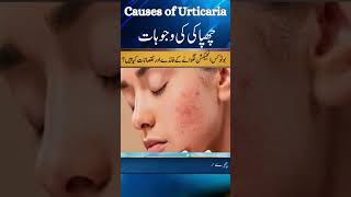 What Causes Urticaria Dr Atif Kazmi Explains Common Triggers [upl. by Hartley]