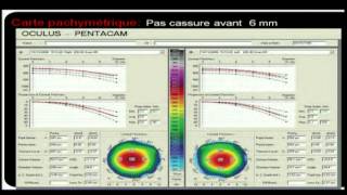 Pentacam bases dinterprétation en chirurgie réfractive [upl. by Artamas441]