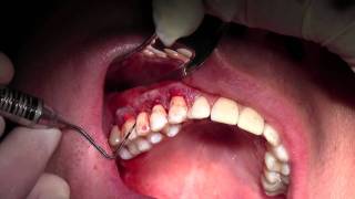 Alloderm Gingival Grafting 36 Sites Graft Suturing [upl. by Woehick]