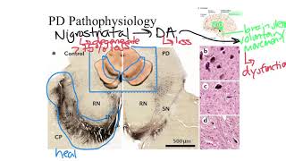 Parkinsons Disease Pathophysiology [upl. by Gweneth]