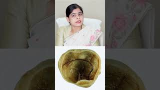 Overian Dermoid Cyst  Dr Soniya Singh  Narayan Swaroop Hospital [upl. by Acenes]