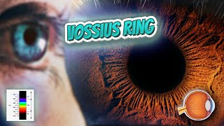 Vossius ring Your EYEBALLS 👁️👁️💉😳💊🔊💯✅ [upl. by Yrroc]