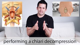 Chiari decompression surgery  how its done [upl. by Terrej68]