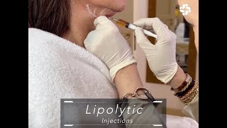 LIPOLYTIC INJECTIONS FOR FACIAL CONTOURING [upl. by Niuqaoj]