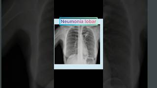 neumonia medicina radiologia anatomy radiografia [upl. by Alain]