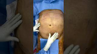 Lipoescultura con Lipotransferencia en paciente MASCULINO de 93 kg 💪🔥 cirugiaplastica lipo [upl. by Webber888]