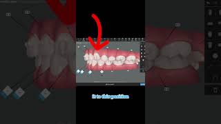 Can Invisalign fix open bite 2023 [upl. by Battista]