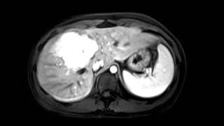 Focal nodular hyperplasia FNH [upl. by Ab]