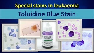 Toluidine blueSpecial stain in leukaemia [upl. by Emanuela]