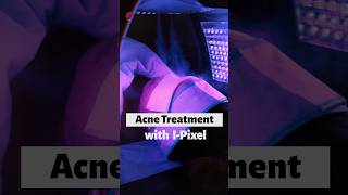 How to Improve Skin Texture  Laser Treatment for Acne  Best Dermatologist in Noida  Skinlogics [upl. by Cathee148]