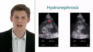 How To Evaluate Hydronephrosis In Point of Care Ultrasound [upl. by Modeste]