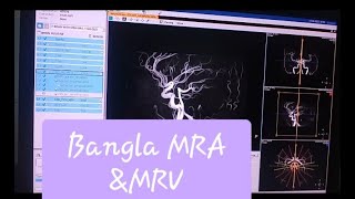 Bangla MRI BRAIN OF MRAampMRV Planning PHILIPS 3Tmriphilips [upl. by Pearle]