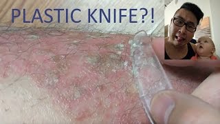 PSORIASIS MAINTENANCE WITH A PLASTIC KNIFE [upl. by Hamehseer]