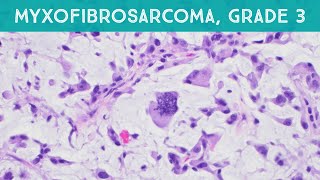 Myxofibrosarcoma grade 3 high grade pathology sarcoma dermpath dermatology dermatopathology [upl. by Kosey]