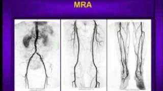 What is Peripheral Arterial Disease [upl. by Dnaltruoc]