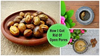 How I Got Rid Of Large OPEN PORES Permanently amp Naturally Using an Ayurvedic Remedy [upl. by Earised]