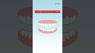 Unleash your perfect smile with toothsi [upl. by Bradski660]