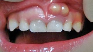 الخراج السني Dental abscess الاسباب الاعراض العلاج [upl. by Winou]