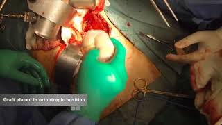 Orthotopic Kidney Transplantation [upl. by Jared]