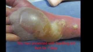 Cellulitis Foot With Blister [upl. by Anide]