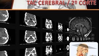 TAC CEREBRAL VIDEO 2 CORTE 2 [upl. by Assennev]