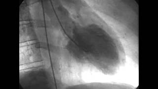 Procedural Coronary Angiography of Coronary Artery Thrombus Aspiration Followed by Bolus Intracorona [upl. by Ahsatin]