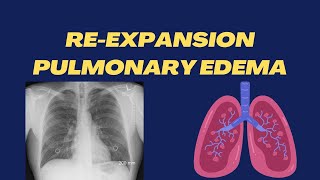 ReExpansion Pulmonary Edema  Simple Explanation  High Yield Points  Respiratory Lecture10 [upl. by Decca]