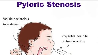 Pyloric Stenosis [upl. by Goodhen397]