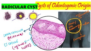 Radicular Cyst  Periapical cyst  HISTOPATHOLOGY  Clinical features  Etiopathogenesis [upl. by Torbart214]