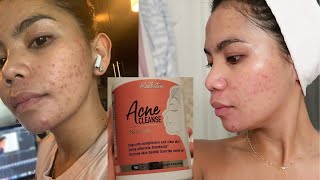 Kallistia Acne Cleanse Skin Care for 30 Days Honest Review Hormonal Acne  My Skin Journey [upl. by Aicnetroh]