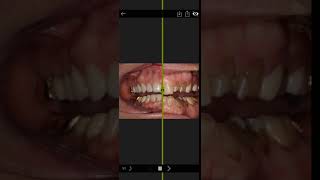 Invisalign Time Lapse Video [upl. by Htezil]