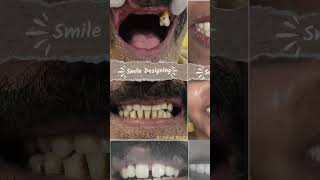 Smile Designing at Lumiya Dental HomeNorth Paravur dentist smile dentalclinic [upl. by Denna763]