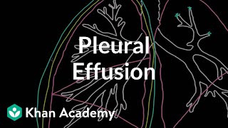 What is a pleural effusion  Respiratory system diseases  NCLEXRN  Khan Academy [upl. by Caraviello]