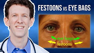 What Are Eye Festoons vs Lower Eyelid Bags [upl. by Lenoil83]