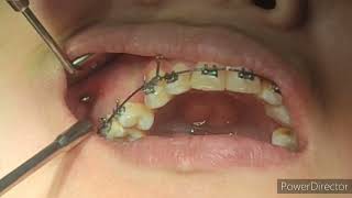 Orthodontic TadsTemporary anchoring device screw installation [upl. by Naneek517]