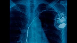 Automatic Implantable CardioverterDefibrillator AICD Explained CureU Healthcare cureuhealthcare [upl. by Olimac540]