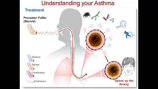 Understanding Your Asthma Part 3 Steroid Medication [upl. by Flita756]